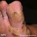 reiter's syndrome