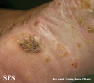 reiter's syndrome