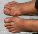 reiter's syndrome