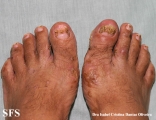 reiter's syndrome