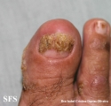 reiter's syndrome