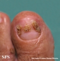 reiter's syndrome