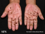 reiter's syndrome
