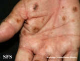reiter's syndrome