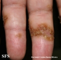 reiter's syndrome