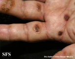 reiter's syndrome