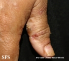 reiter's syndrome