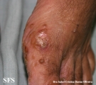 reiter's syndrome