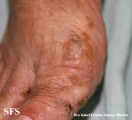reiter's syndrome