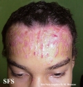 epidermolysis bullosa pruriginosa