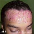 epidermolysis bullosa pruriginosa