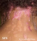 epidermolysis bullosa pruriginosa
