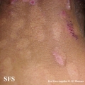 epidermolysis bullosa pruriginosa