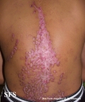 epidermolysis bullosa pruriginosa