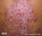 epidermolysis bullosa pruriginosa