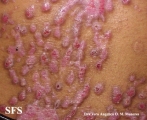 epidermolysis bullosa pruriginosa
