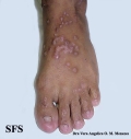 epidermolysis bullosa pruriginosa