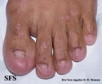 epidermolysis bullosa pruriginosa