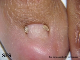 epidermolysis bullosa pruriginosa
