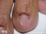 epidermolysis bullosa pruriginosa