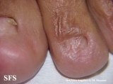 epidermolysis bullosa pruriginosa