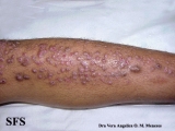 epidermolysis bullosa pruriginosa