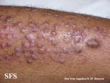 epidermolysis bullosa pruriginosa