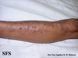 epidermolysis bullosa pruriginosa