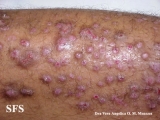 epidermolysis bullosa pruriginosa