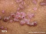 epidermolysis bullosa pruriginosa