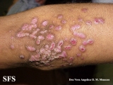 epidermolysis bullosa pruriginosa