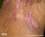 epidermolysis bullosa pruriginosa