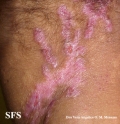 epidermolysis bullosa pruriginosa