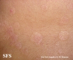 epidermolysis bullosa pruriginosa