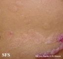 epidermolysis bullosa pruriginosa