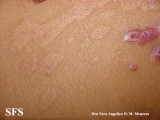 epidermolysis bullosa pruriginosa