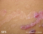 epidermolysis bullosa pruriginosa