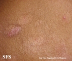 epidermolysis bullosa pruriginosa