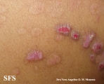 epidermolysis bullosa pruriginosa