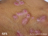 epidermolysis bullosa pruriginosa