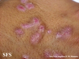 epidermolysis bullosa pruriginosa