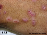 epidermolysis bullosa pruriginosa