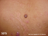 epidermolysis bullosa pruriginosa