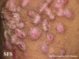 epidermolysis bullosa pruriginosa
