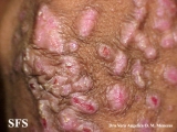 epidermolysis bullosa pruriginosa
