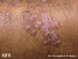 epidermolysis bullosa pruriginosa