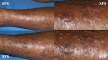 epidermolysis bullosa pruriginosa