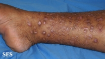 epidermolysis bullosa pruriginosa