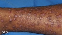 epidermolysis bullosa pruriginosa
