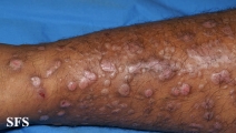 epidermolysis bullosa pruriginosa
